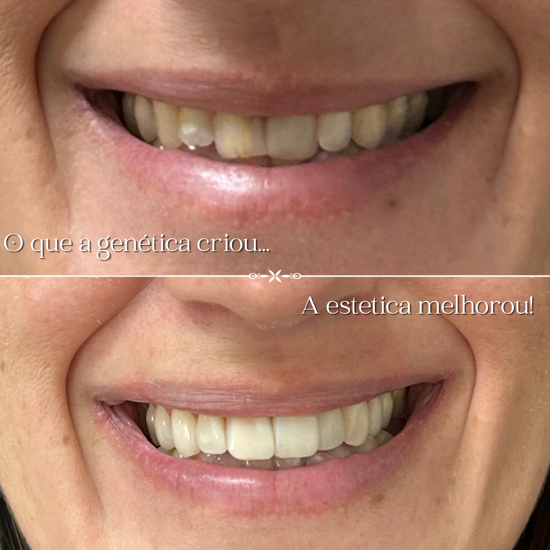 Antes e depois de reabilitação com prótese total
