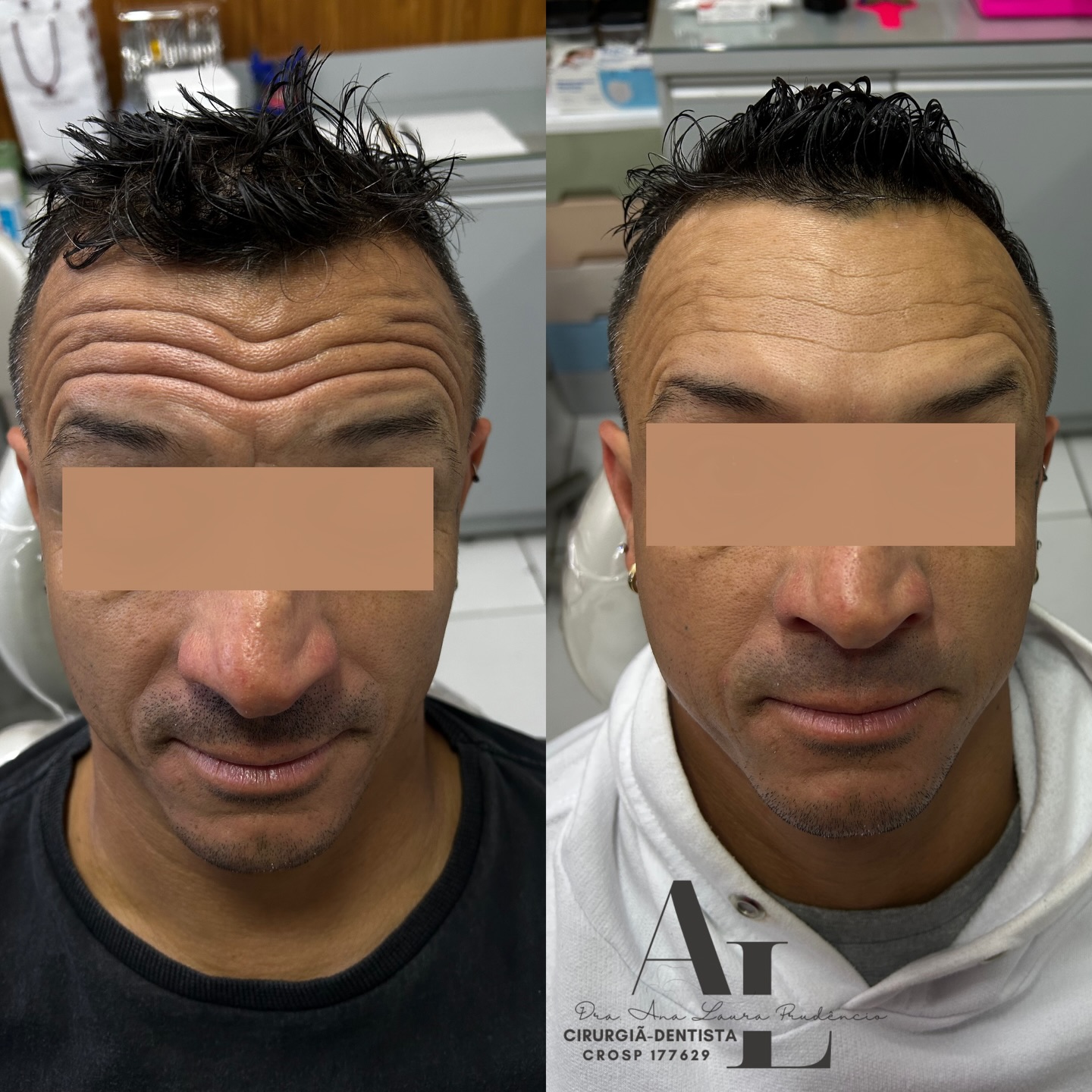 Antes e depois de toxina botulínica na testa de um paciente